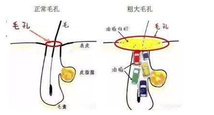  「粗大」还在为毛孔粗大而烦恼吗？集美们，看过来，这样做让你的肌肤细嫩无瑕！