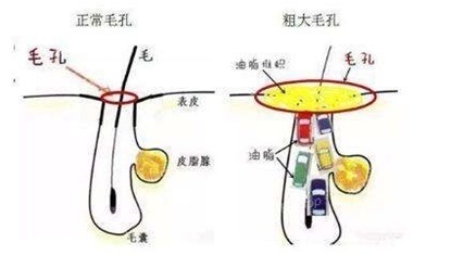「粗大」还在为毛孔粗大而烦恼吗?集美们,看过来,这样做让你的肌肤细嫩无瑕!