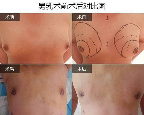  『恢复』济南乳腺病医院：男乳术后两侧乳房恢复的速度不一致，怎么回事？