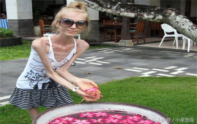 俄罗斯女子为减肥变成活骷髅，体重只剩42斤