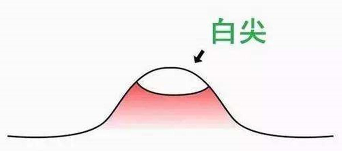  『脸上长』痘痘真不能“挤”？这误会大了，挤痘其实能让痘痘消得更快！