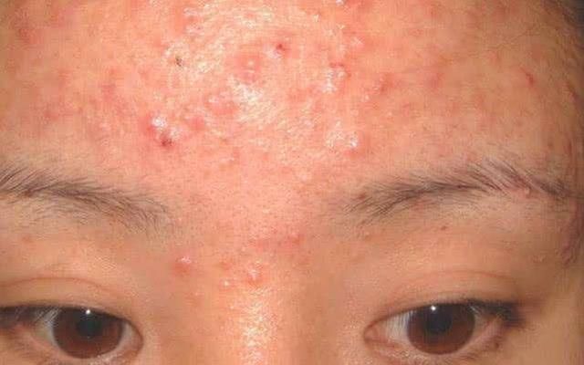 痘痘经久不消内藏“毒脓”, 2种天然物专祛痘，清空毛孔排出痘毒