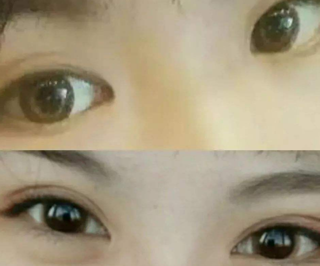 天然双眼皮和割出来的双眼皮，究竟区别在哪？涨知识了！