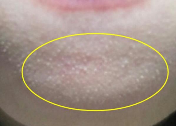 下巴紧绷后凸起的“白色米粒”，竟让我不敢抬头，清退只需2招