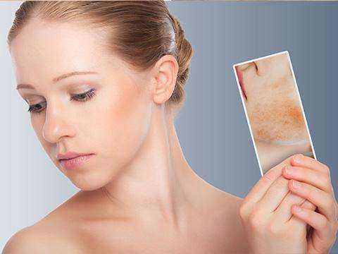 意外长痘除不掉?螨虫作祟,每天洗脸用“它”抹一抹祛除痘痘