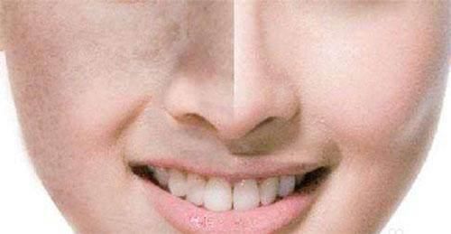 脸上没有螨虫的3大迹象，看看你占了几个?