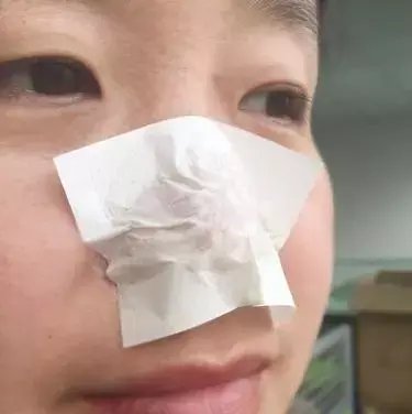  【白净】黑头太多不要怕, 巧用四招搞定草莓鼻, 白净无瑕的对手