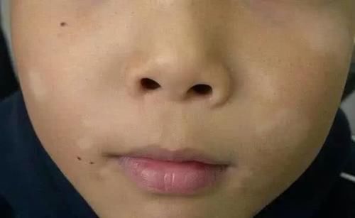  [搞定]儿科医生：孩子脸上有白斑，先别急着“打虫”，补点维生素就搞定