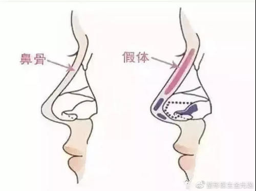 『医生』关于隆鼻术后假体偏斜的原因,你知道吗?
