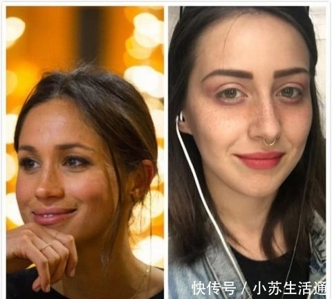 手术@英女子痴迷梅根“雀斑妆”,拙劣手术让面部毁容,花3万治疗修复