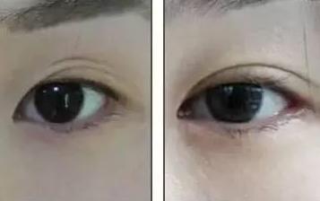 一双眼睛毁掉整张脸，这几种眼睛做双眼皮美爆了，有你没有？