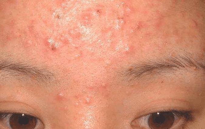 4个异常出现脸部, 十有八九是螨虫, 常用2招除螨, 行之有效