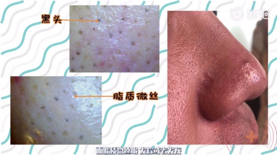 家用去黑头产品测评,这个东西对皮肤的伤害竟然这么大!