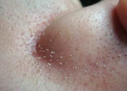 皮肤这样是有螨虫，很多人不知道，教你一招