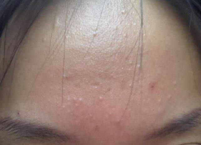 脸上起这种疙瘩, 会痒, 抓破后还能掉出硬邦邦米粒, 居然是这3物