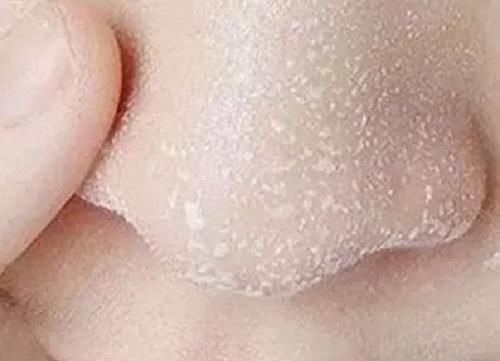  【小妙】4月发文：去黑头小妙招，教你如何去除黑头
