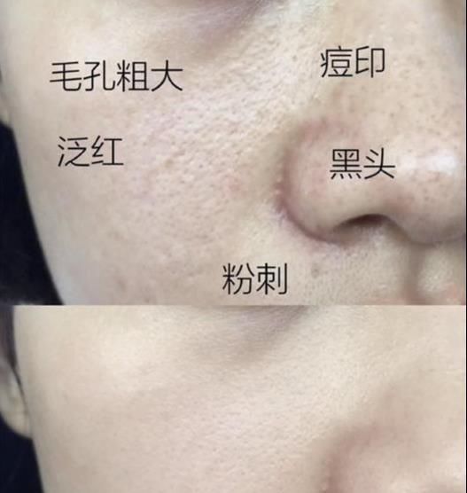  #毛孔粗大#是不是30岁之后,女人的皮肤就开始走下坡路了?