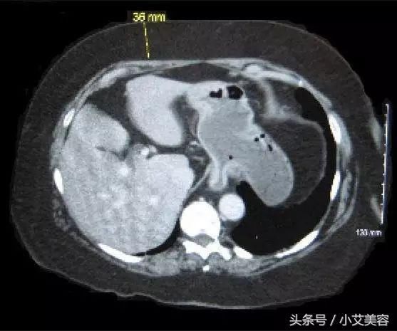 99%的女生显胖不是因为体重增加，而是脂肪在身体的比例占得太多