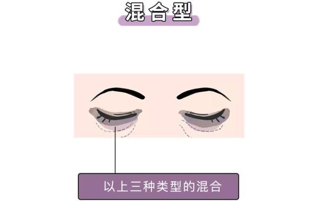  『刷屏』问壹点｜“本人黑眼圈证明”刷屏？壹起扒一扒黑眼圈的前世今生