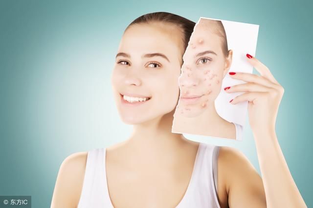 黑头痘痘多，脸上多半螨虫暗潮蠕动，3招除螨，祛痘变得很简单