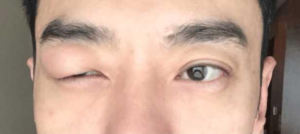 男星因被蚊子咬到致剧组停工，被骂耍大牌，网友：位置太尴尬！