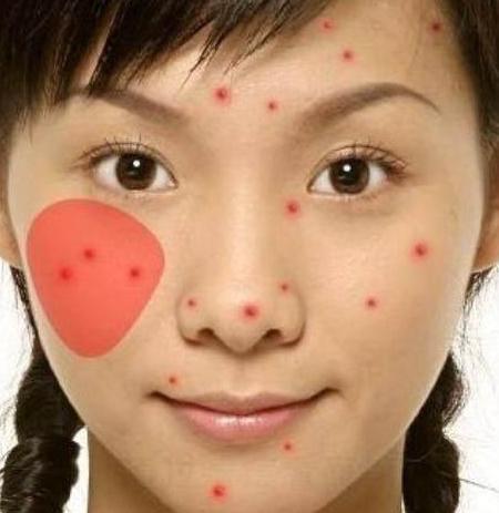 三伏天痘痘频发, 出现3个症状要警惕了, 毛孔可能被螨虫堵住了