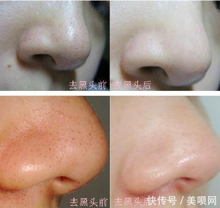  去除黑头：鼻子上黑头多怎么办，这样做让你告别“草莓鼻”