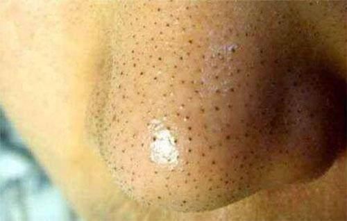 脸上长期有4表现，对不起，螨虫在你毛孔中做窝，交配繁殖下一代