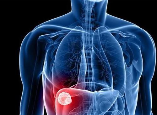 肝癌不痒不痛，身体出现这6个信号，说明体内癌细胞正在扩散