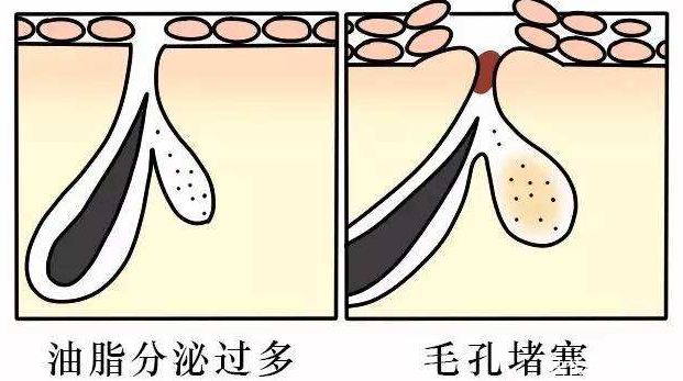 「粗大」还在为毛孔粗大而烦恼吗?集美们,看过来,这样做让你的肌肤细嫩无瑕!
