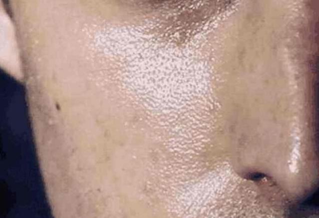 每天洗脸，鼻子上还能挤出小米粒，是螨虫一遍遍在毛孔制造垃圾！