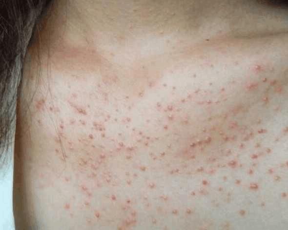 警告：后背有这5个“奇怪的现象”, 是螨虫在向你“打招呼”了