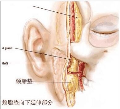 去颊脂垫术后脸部会凹陷吗？