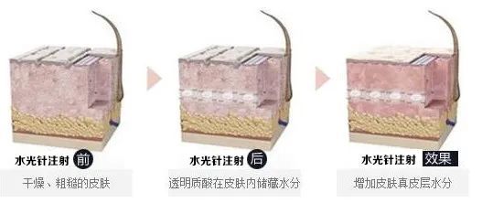 「皮下组织」热门医美项目“水光针”,真的有效果吗?