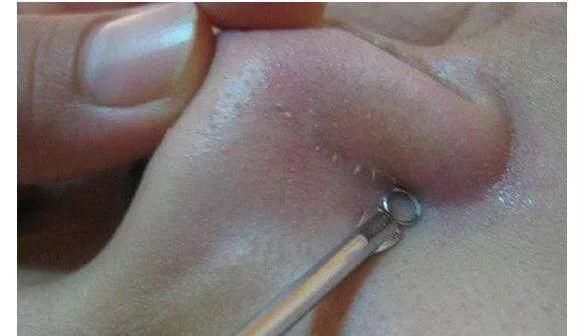 鼻头里挤出这么多“小黄粒”, 原来是脸上螨虫过亿，3招教你除螨