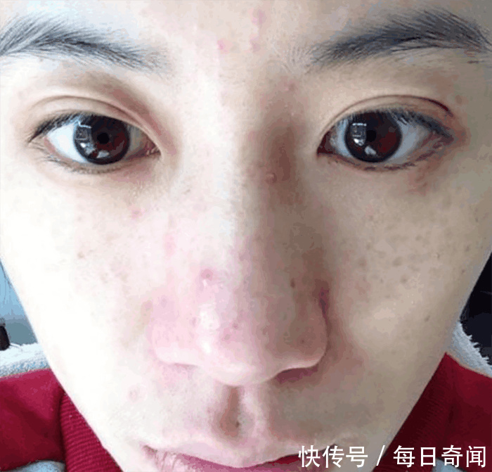 皮肤变成螨虫窝竟浑然不知,3方法教你自检,十试九中2招根除