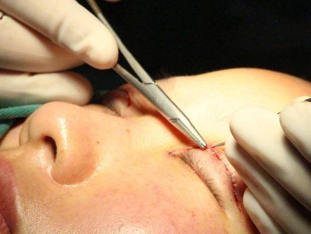 一双眼睛毁掉整张脸，这几种眼睛做双眼皮美爆了，有你没有？