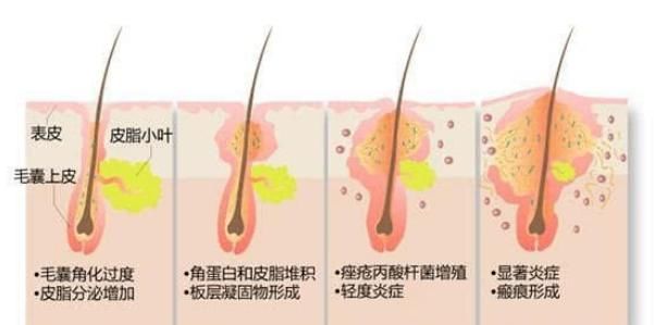  『脸上』脸上长痘痘不想留下痕迹，学会2个小技巧，远离痘印让你更加美丽