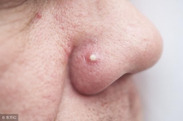 鼻头里挤出这么多“小黄粒”,证明脸上螨虫过亿，3招教你逼退螨虫