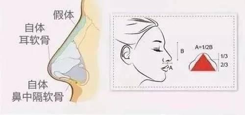  『和医生』隆鼻有哪些副作用？小心这5大后遗症等着你