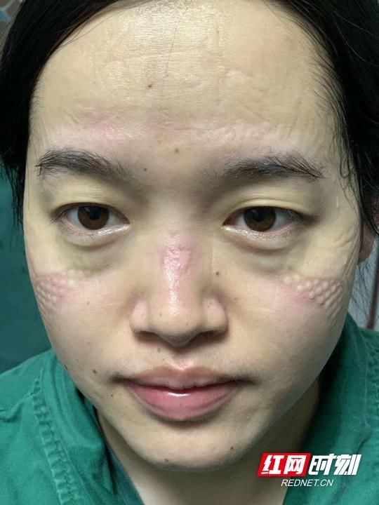  【泸溪县人民】组图丨她摘下口罩后的压痕，让人看哭了