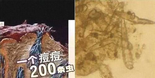 皮肤长满了痘痘粉刺?是螨虫在作怪,该怎么排出来?懊悔知道的太晚