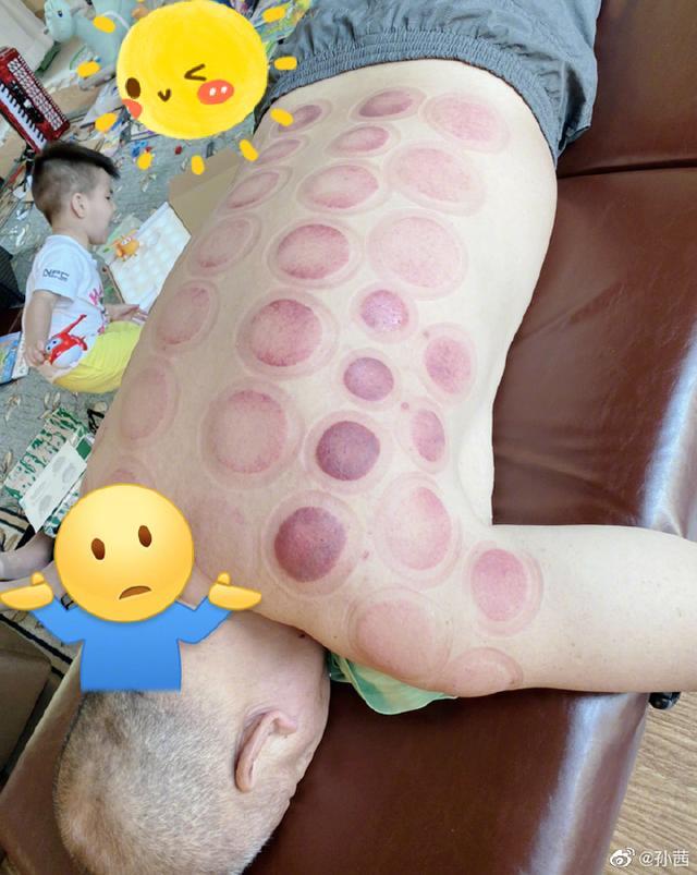 「上线」孝顺女上线!孙茜为家人拔火罐,老父亲后背全是淤青看着就疼