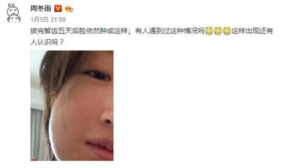 周冬雨拔智齿几颗