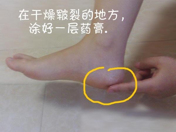 『提醒』46岁女子脚跟裂口,平时不穿高跟鞋,提醒:4个习惯也会毁掉健康