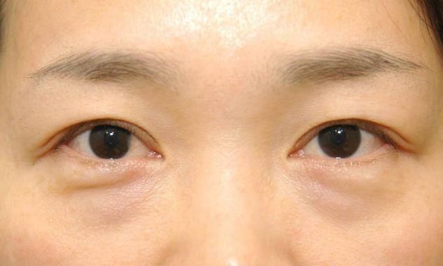 『女性』分不清“卧蚕”和“眼袋”？专家告诉你区别在哪，女性了解下