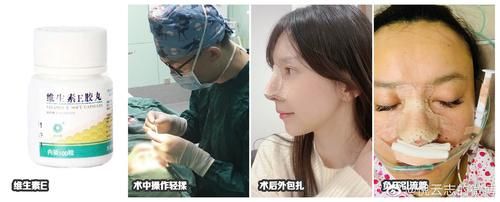 #瘢痕增生#术后恢复期很重要的三个阶段,需要如何进行护理?