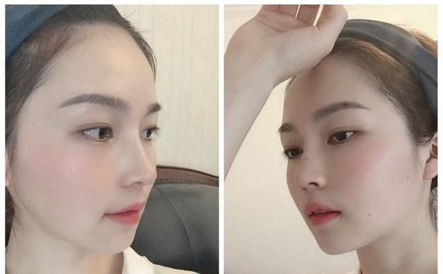  #术后#隆鼻真的有用吗？鼻综合术后六个月记录，这完全不是一个人！