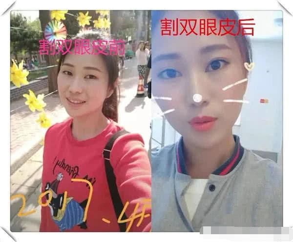 好看|割双眼皮前VS割双眼皮后,看见差距,眼睛变好看了但灵魂没了!