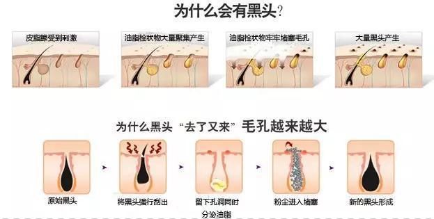 市面上那么多去黑头的产品，快来看看你用的是哪类？